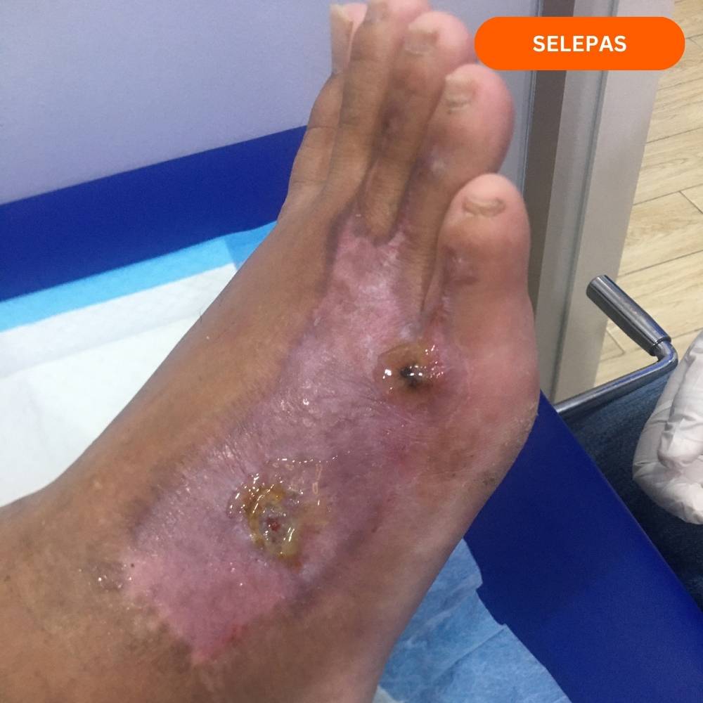 Selepas Cuci Luka 1